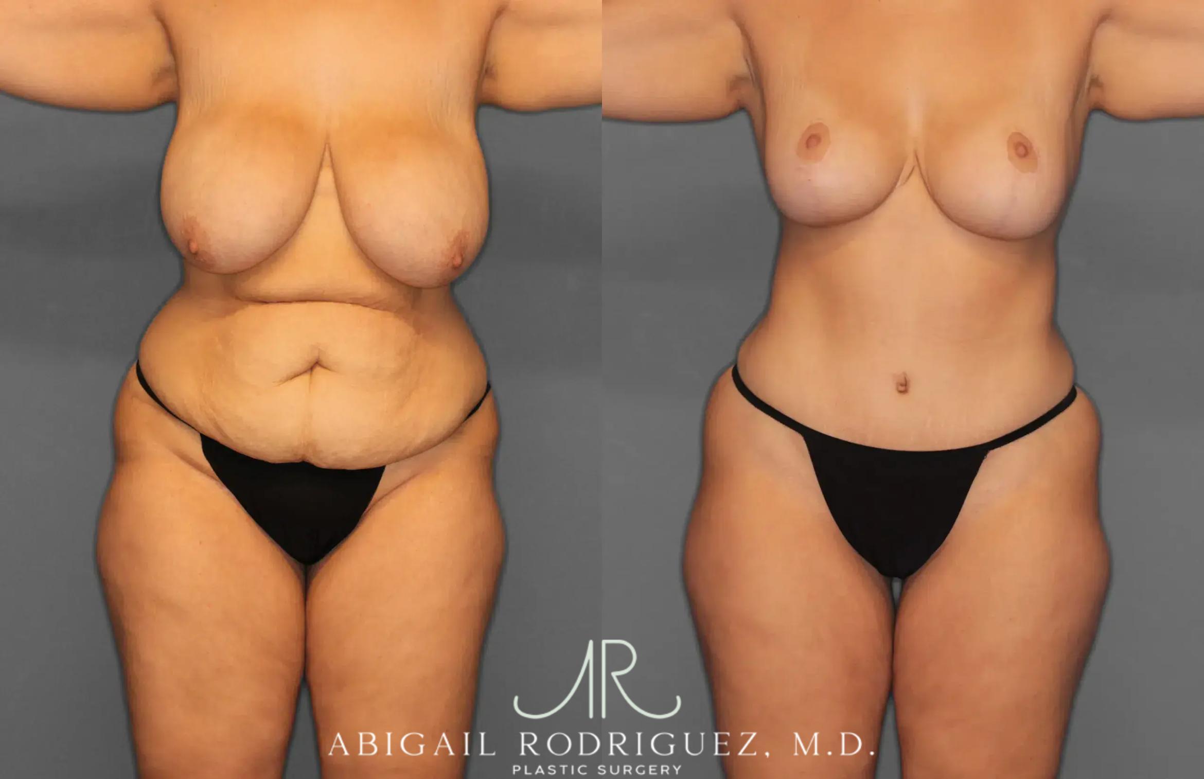 Before & After Tummy Tuck Case 259238 View 1 View in Houston, TX