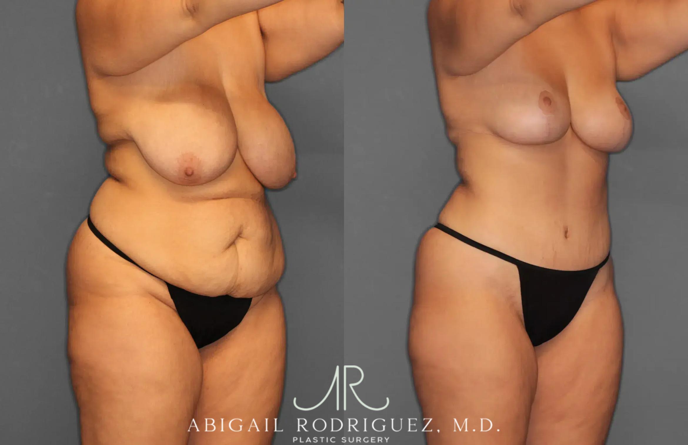 Before & After Tummy Tuck Case 259238 View 10 View in Houston, TX