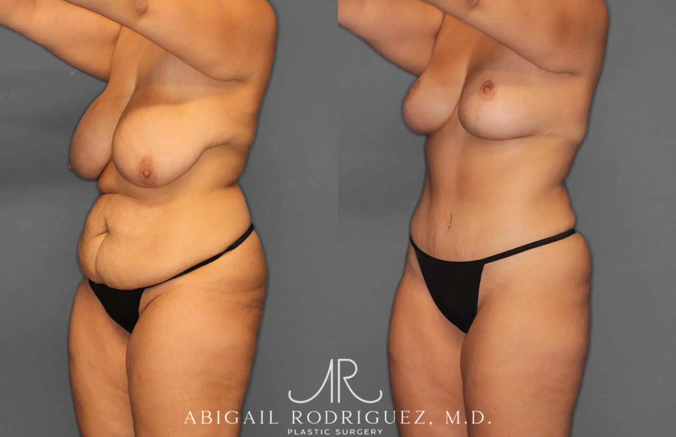 Before & After Tummy Tuck Case 259238 View 2 View in Houston, TX