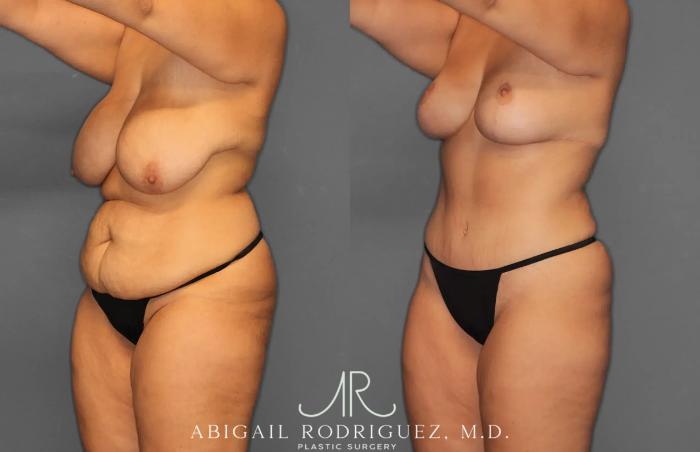 Before & After Tummy Tuck Case 259238 View 2 View in Houston, TX