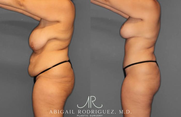 Before & After Tummy Tuck Case 259238 View 3 View in Houston, TX