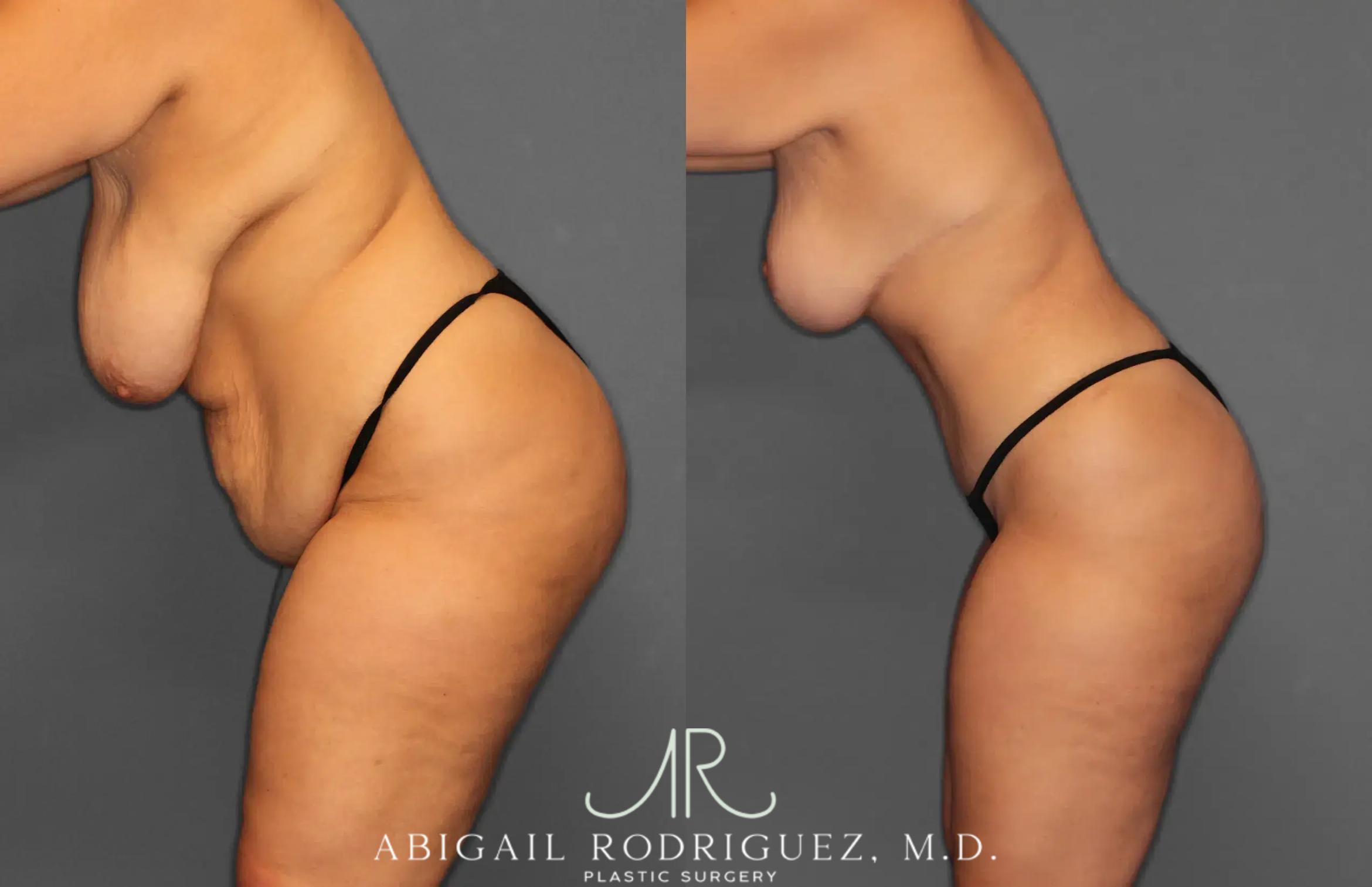 Before & After Tummy Tuck Case 259238 View 4 View in Houston, TX