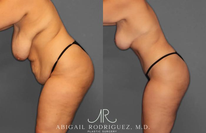 Before & After Tummy Tuck Case 259238 View 4 View in Houston, TX
