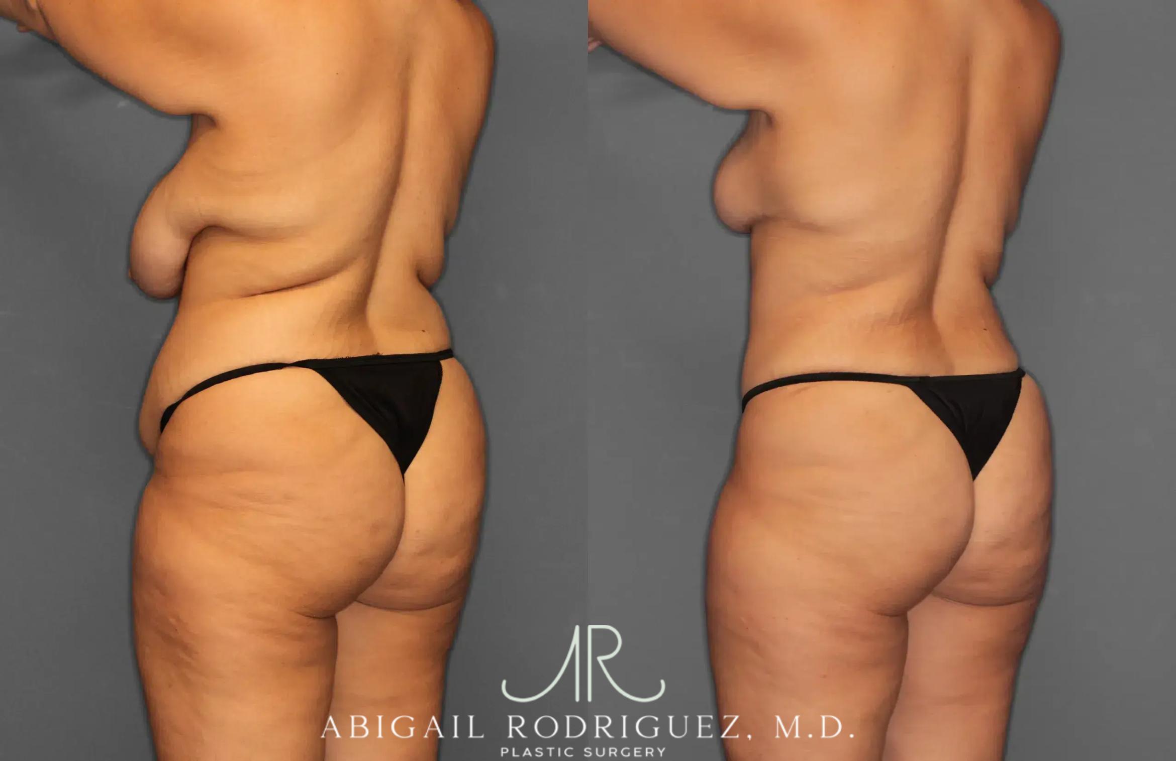 Before & After Tummy Tuck Case 259238 View 5 View in Houston, TX
