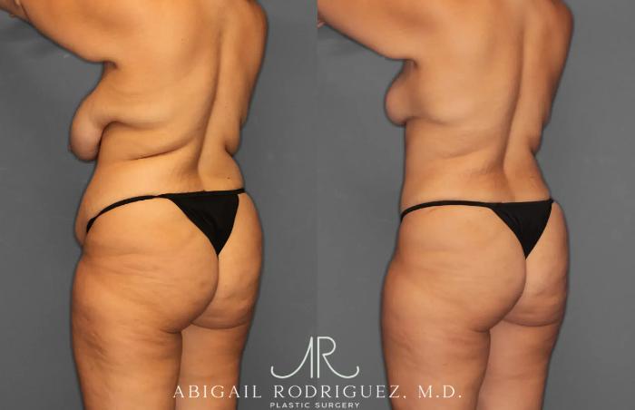 Before & After Tummy Tuck Case 259238 View 5 View in Houston, TX