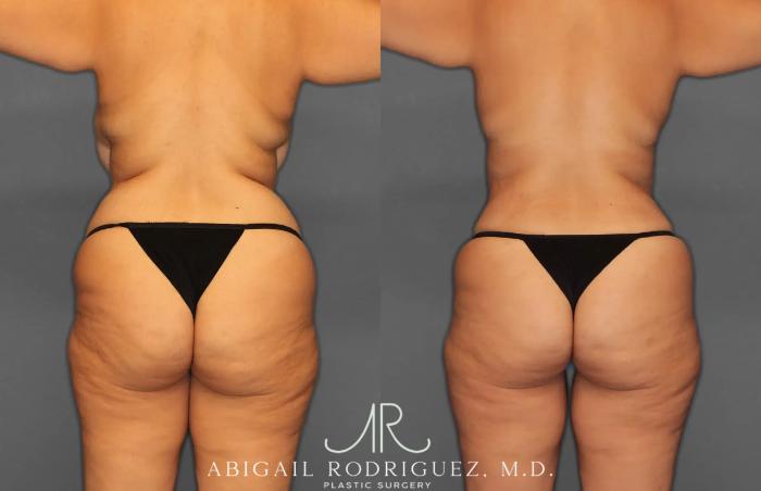 Before & After Tummy Tuck Case 259238 View 6 View in Houston, TX
