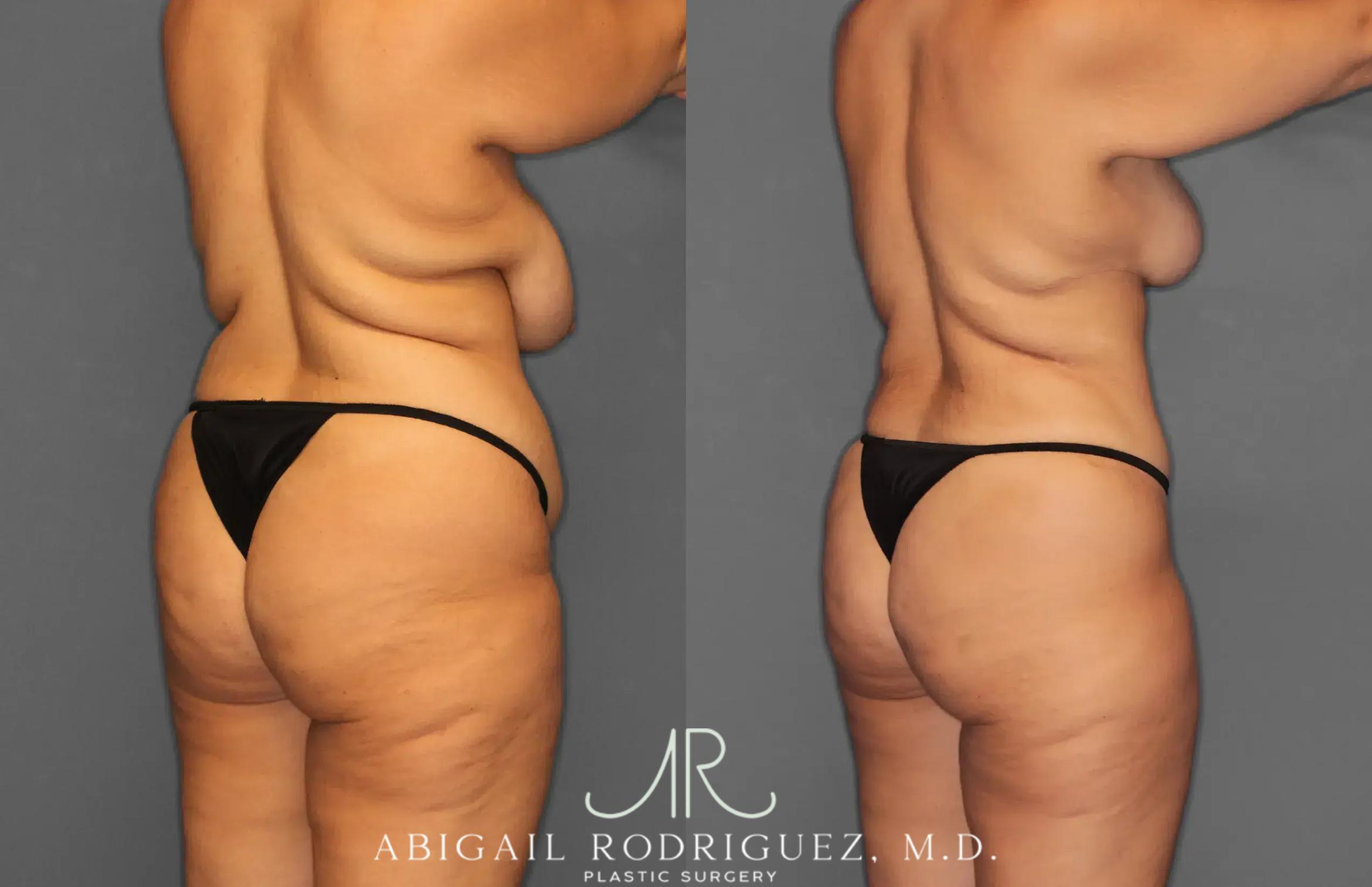 Before & After Tummy Tuck Case 259238 View 7 View in Houston, TX