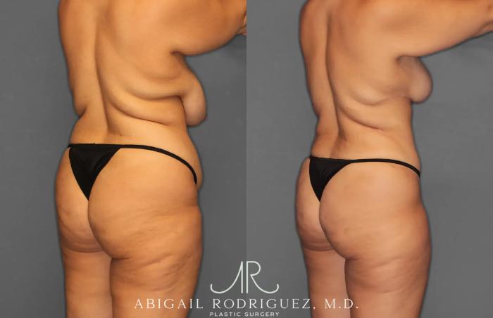 Before & After Tummy Tuck Case 259238 View 7 View in Houston, TX