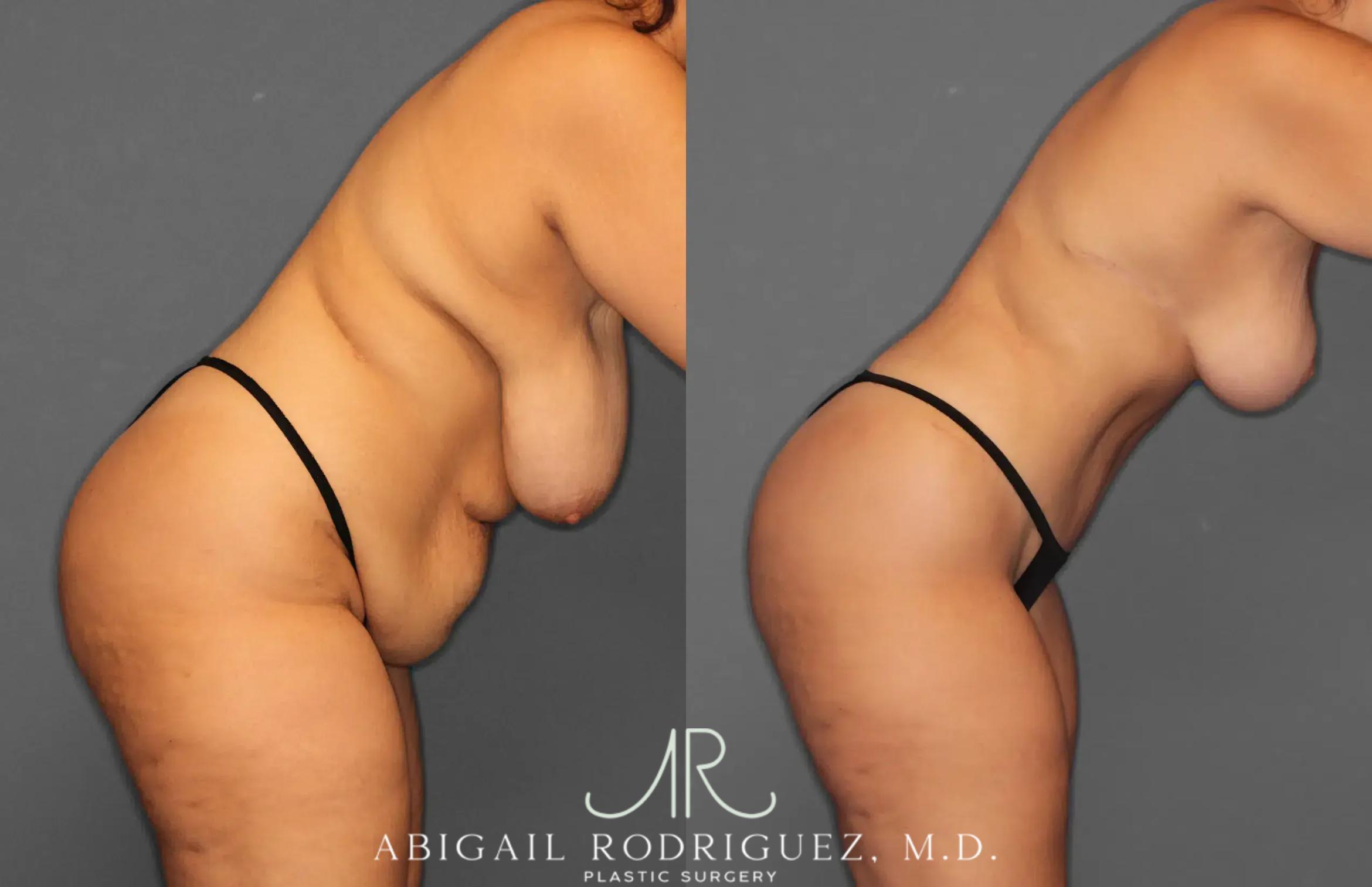 Before & After Tummy Tuck Case 259238 View 8 View in Houston, TX