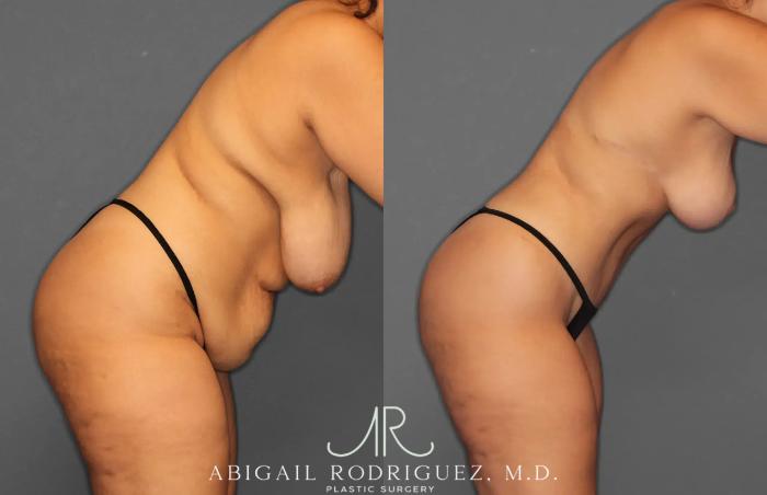 Before & After Tummy Tuck Case 259238 View 8 View in Houston, TX