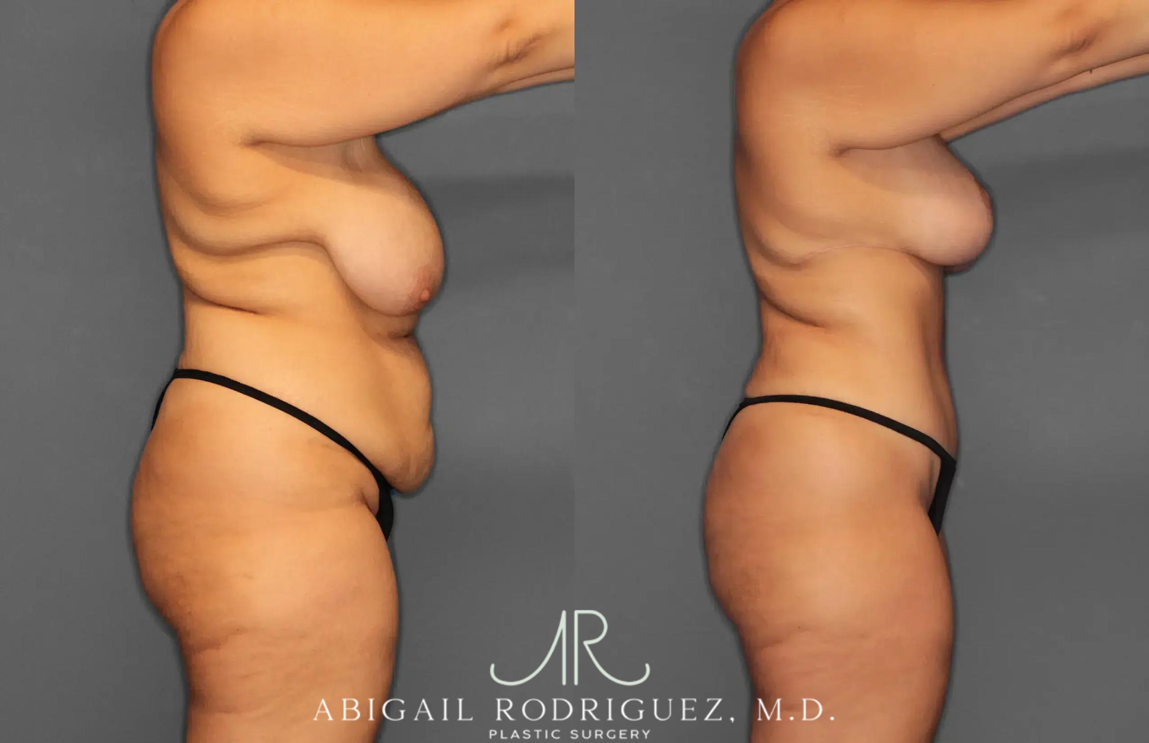 Before & After Tummy Tuck Case 259238 View 9 View in Houston, TX