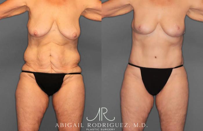 Before & After Tummy Tuck Case 259292 View 1 View in Houston, TX
