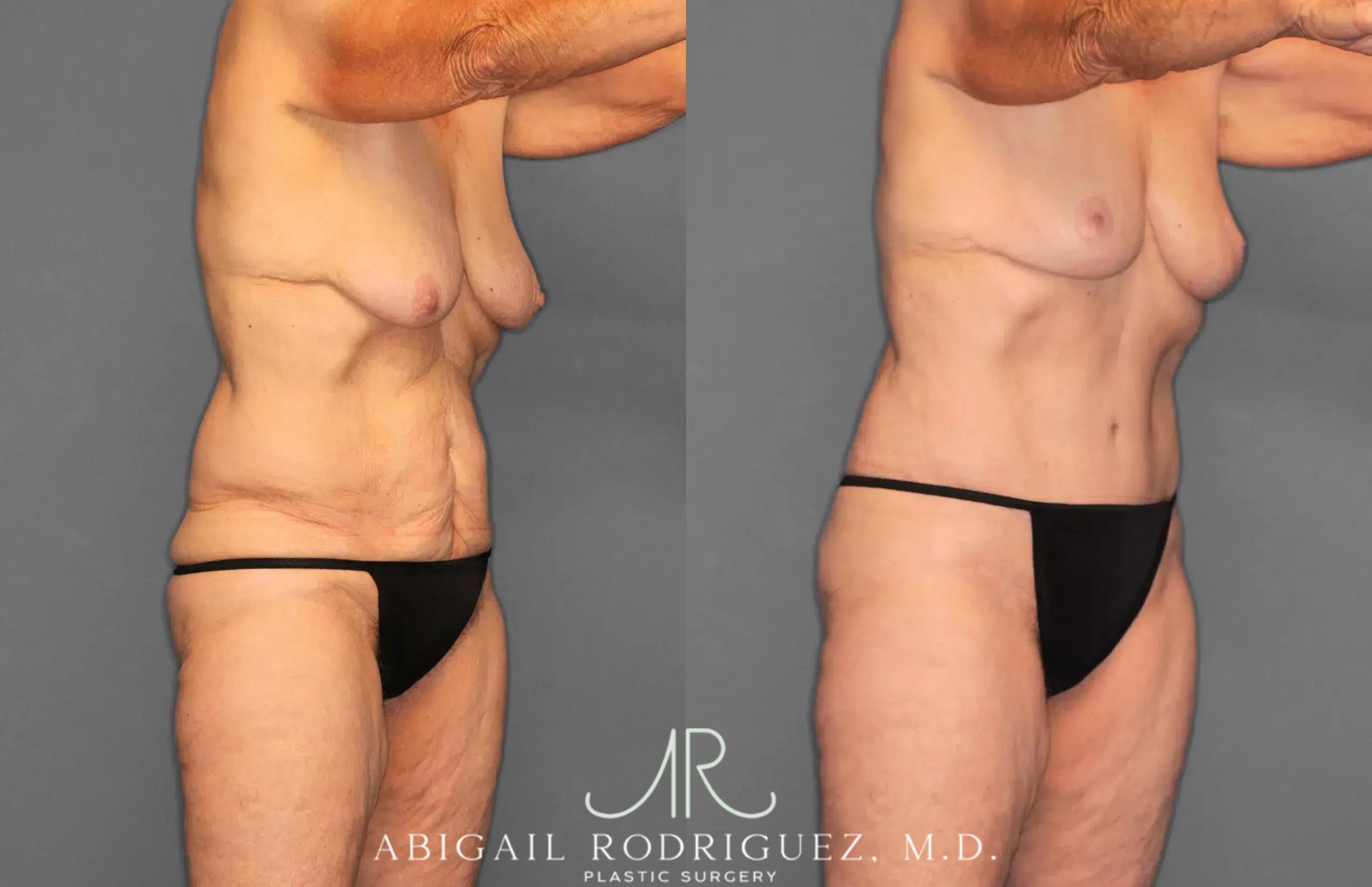 Before & After Tummy Tuck Case 259292 View 10 View in Houston, TX