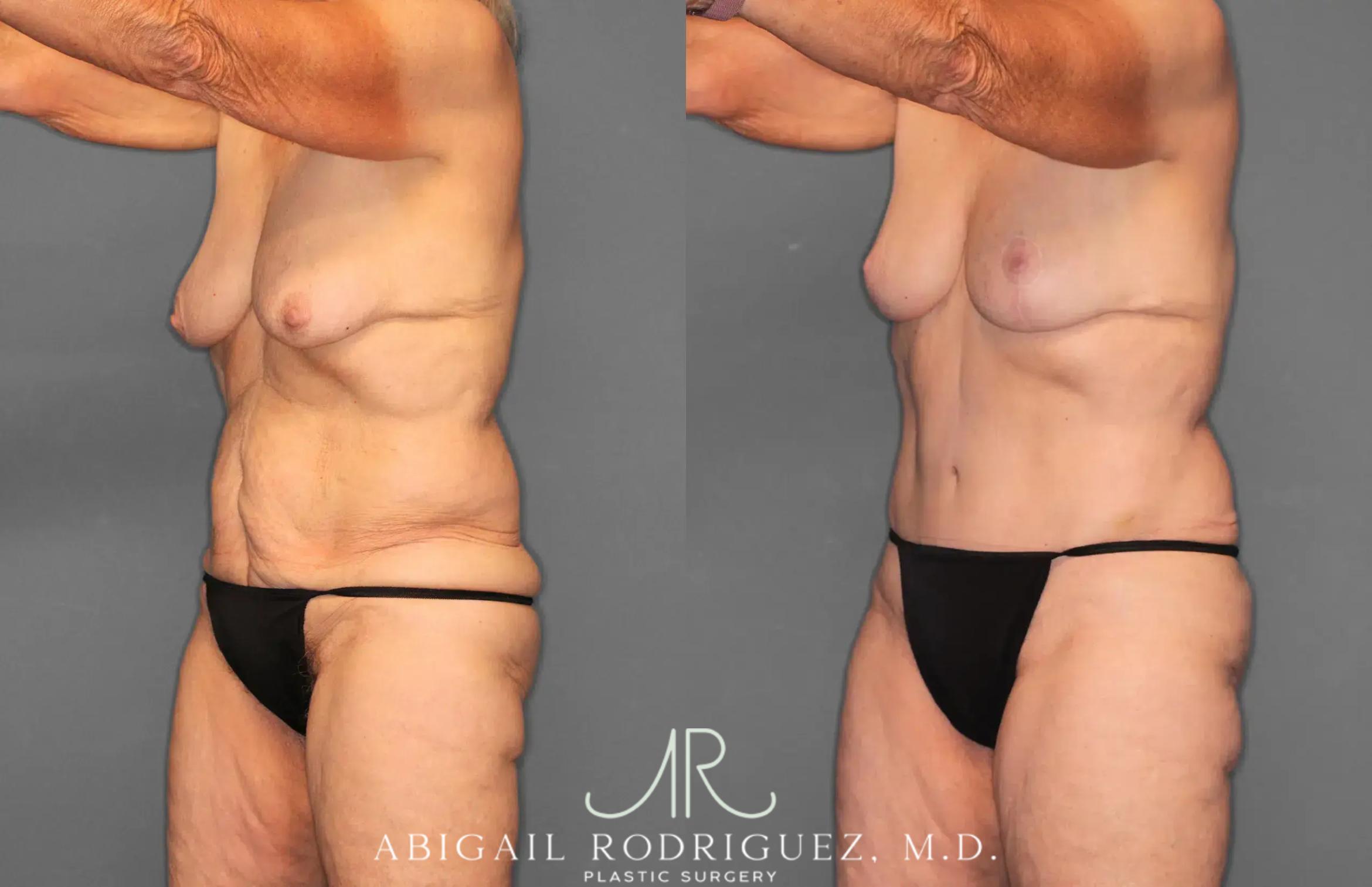 Before & After Tummy Tuck Case 259292 View 2 View in Houston, TX