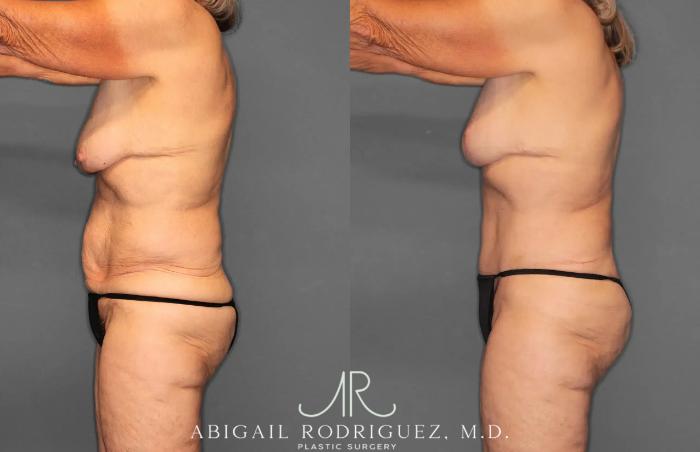 Before & After Tummy Tuck Case 259292 View 3 View in Houston, TX