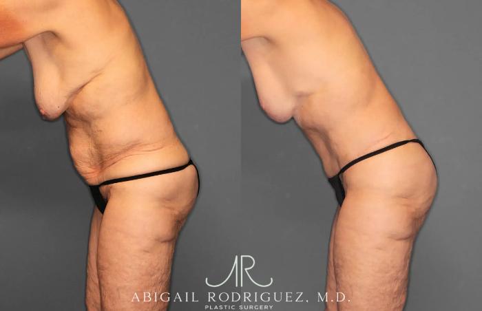 Before & After Tummy Tuck Case 259292 View 4 View in Houston, TX
