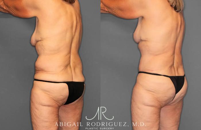 Before & After Tummy Tuck Case 259292 View 5 View in Houston, TX