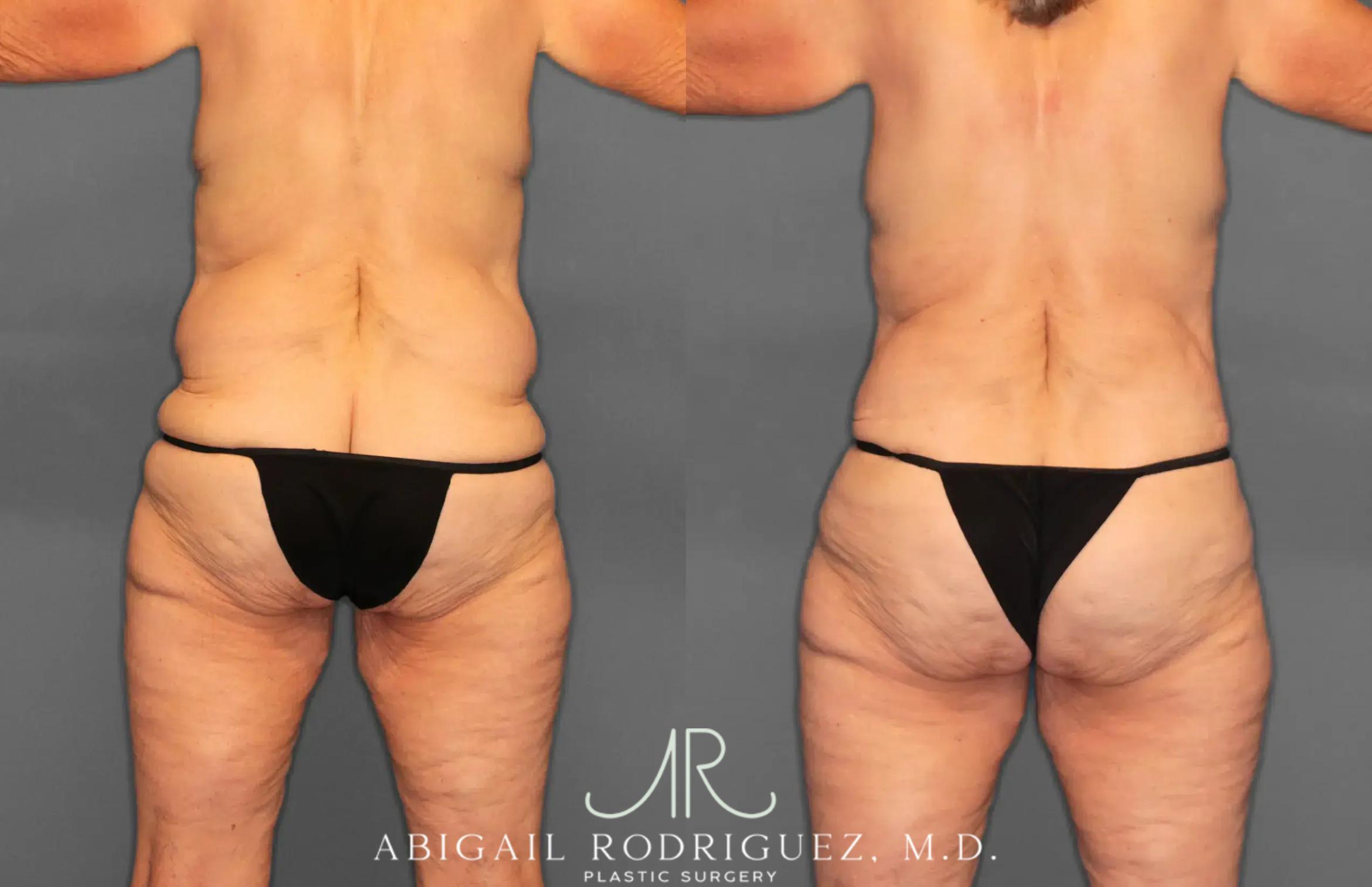 Before & After Tummy Tuck Case 259292 View 6 View in Houston, TX