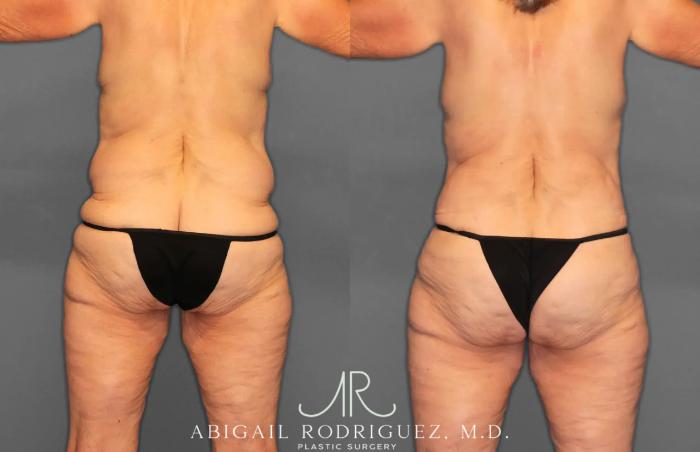 Before & After Tummy Tuck Case 259292 View 6 View in Houston, TX