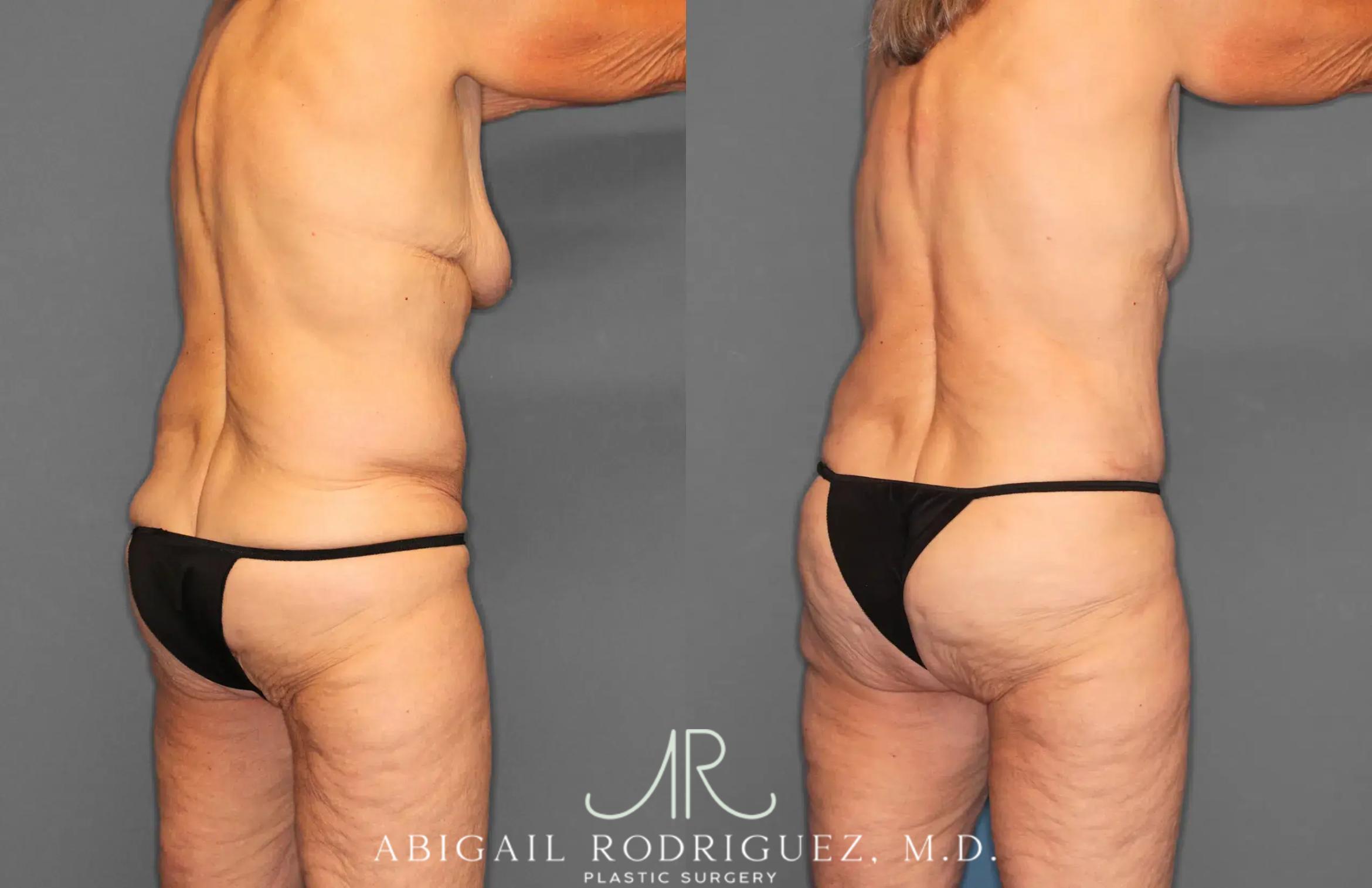 Before & After Tummy Tuck Case 259292 View 7 View in Houston, TX