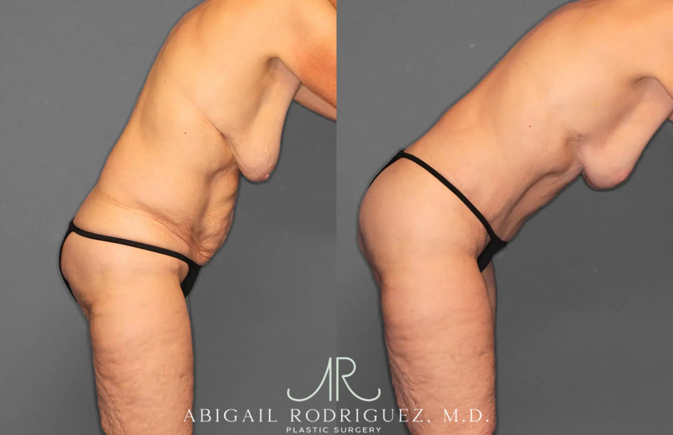 Before & After Tummy Tuck Case 259292 View 8 View in Houston, TX