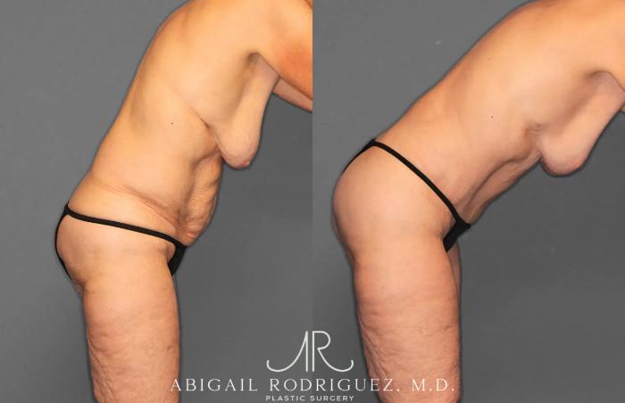 Before & After Tummy Tuck Case 259292 View 8 View in Houston, TX