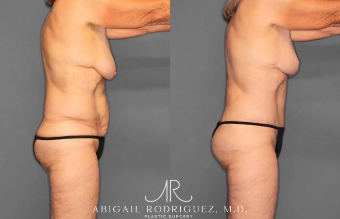 Before & After Tummy Tuck Case 259292 View 9 View in Houston, TX