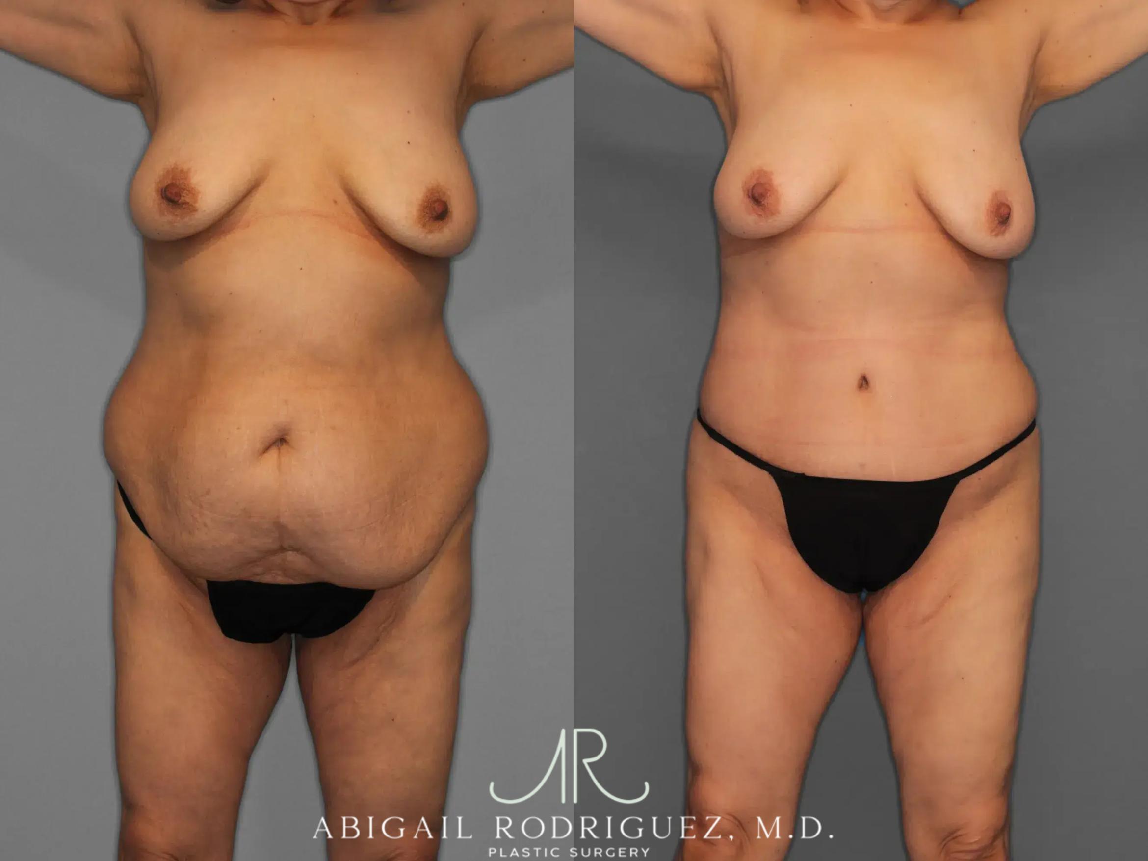 Before & After Tummy Tuck Case 259348 View 1 View in Houston, TX