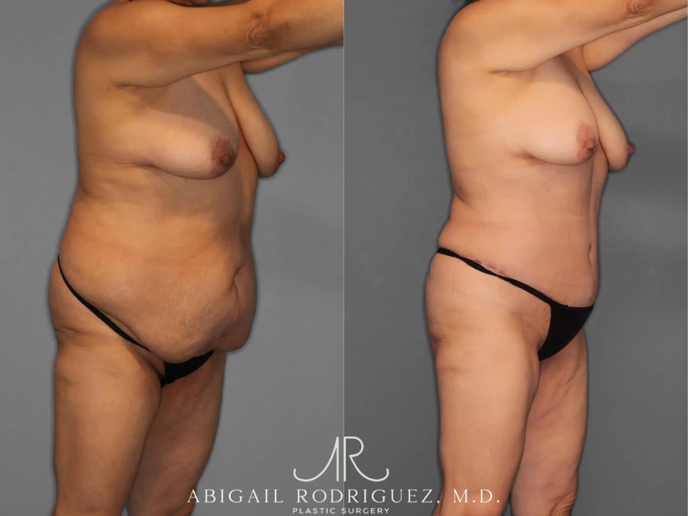 Before & After Tummy Tuck Case 259348 View 10 View in Houston, TX