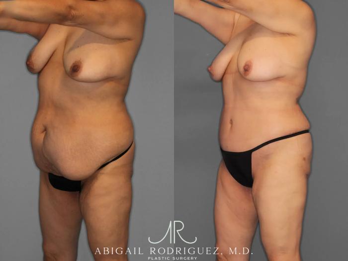 Before & After Tummy Tuck Case 259348 View 2 View in Houston, TX