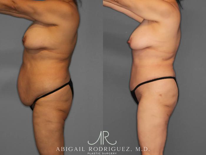 Before & After Tummy Tuck Case 259348 View 3 View in Houston, TX