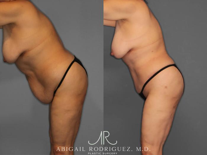 Before & After Tummy Tuck Case 259348 View 4 View in Houston, TX