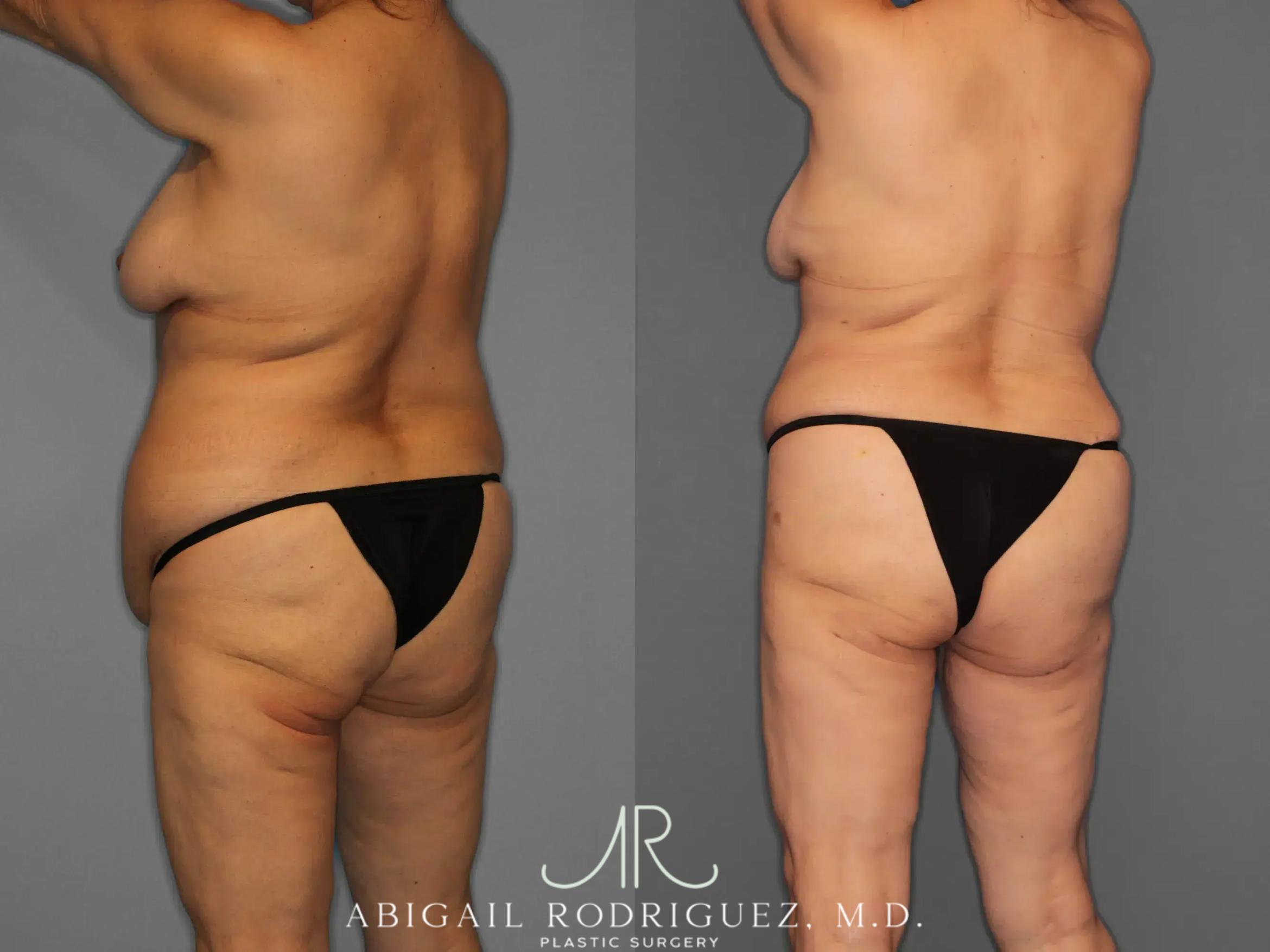 Before & After Tummy Tuck Case 259348 View 5 View in Houston, TX