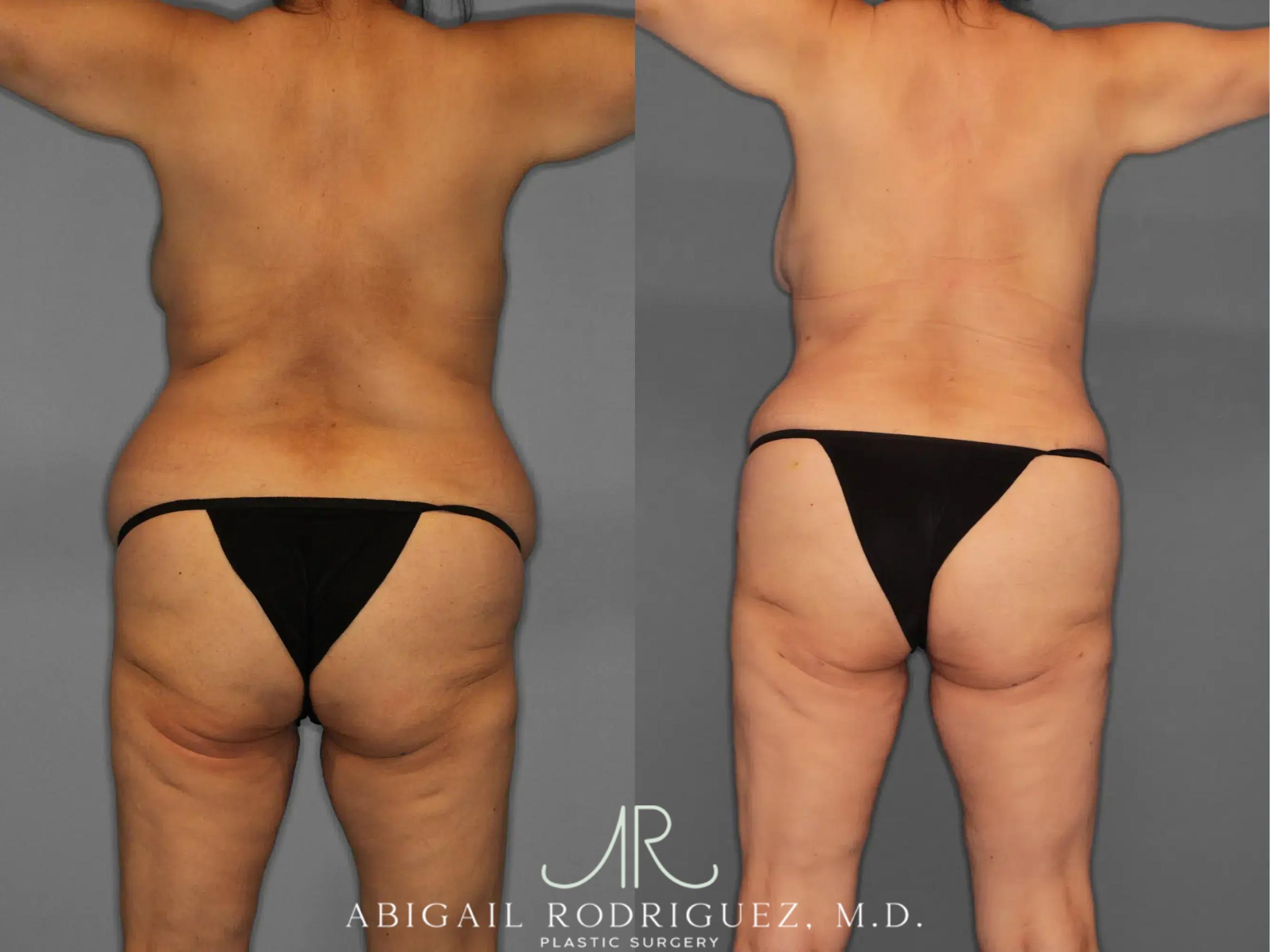 Before & After Tummy Tuck Case 259348 View 6 View in Houston, TX
