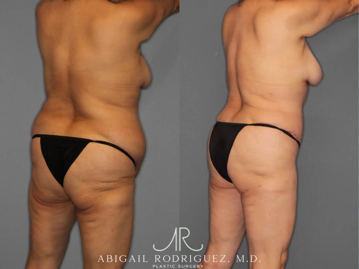 Before & After Tummy Tuck Case 259348 View 7 View in Houston, TX
