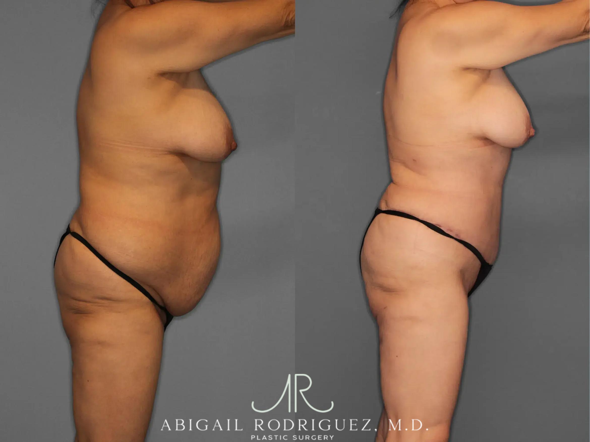 Before & After Tummy Tuck Case 259348 View 8 View in Houston, TX