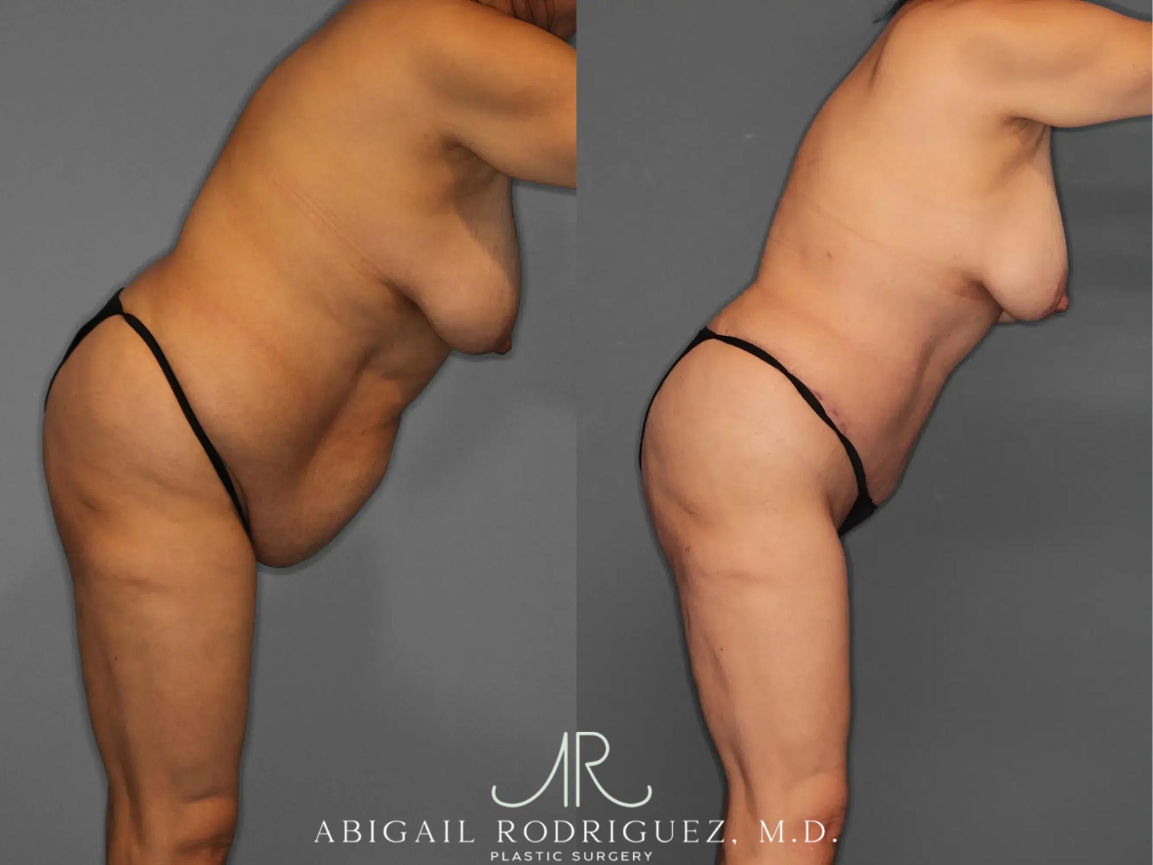 Before & After Tummy Tuck Case 259348 View 9 View in Houston, TX