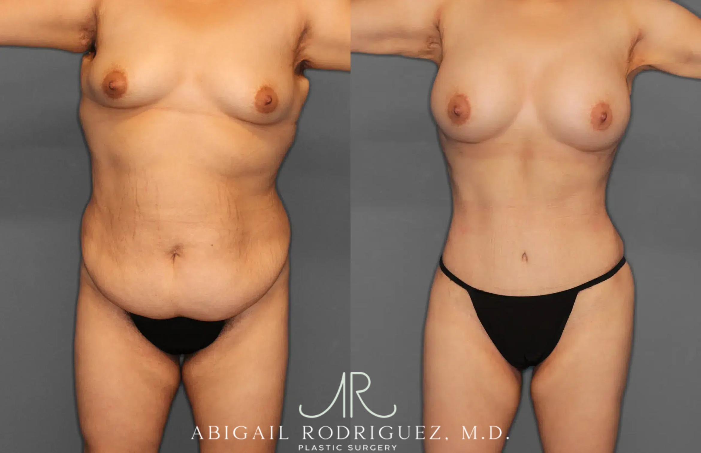 Before & After Tummy Tuck Case 259396 View 1 View in Houston, TX