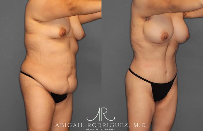 Before & After Tummy Tuck Case 259396 View 10 View in Houston, TX