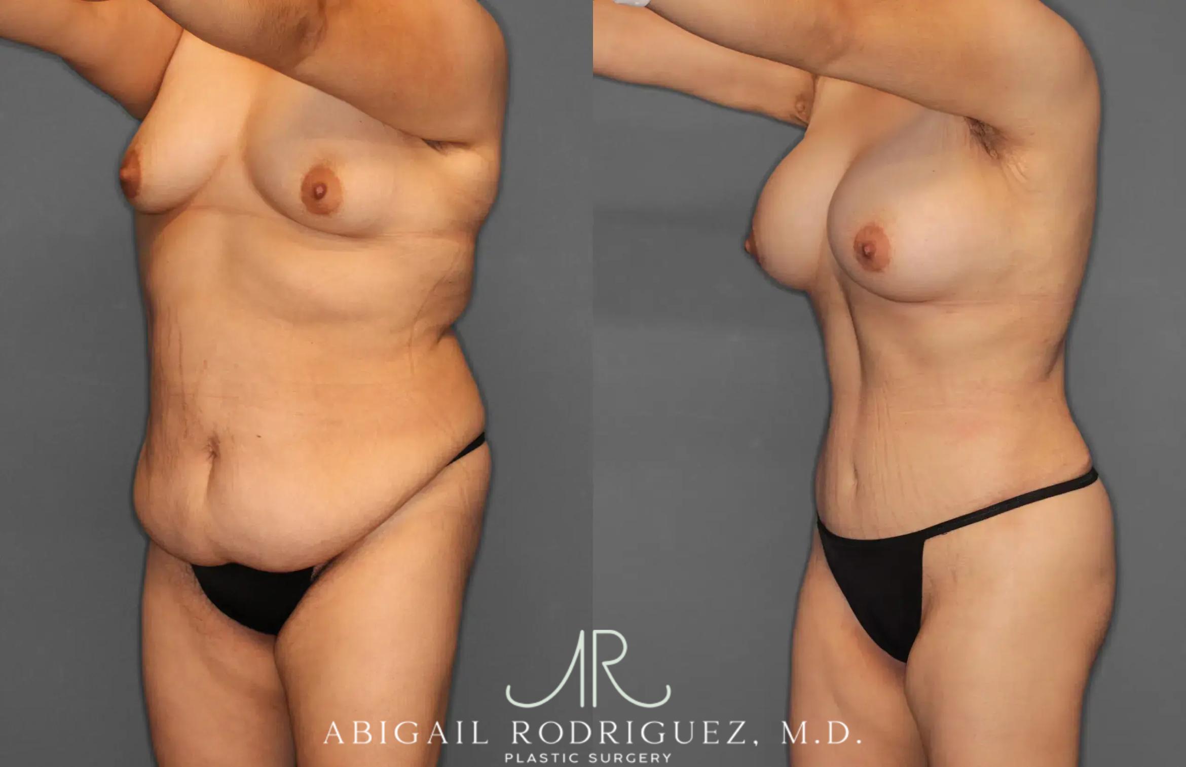 Before & After Tummy Tuck Case 259396 View 2 View in Houston, TX