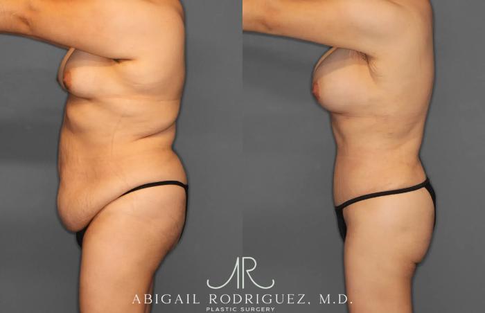 Before & After Tummy Tuck Case 259396 View 3 View in Houston, TX