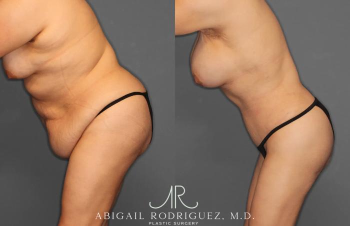 Before & After Tummy Tuck Case 259396 View 4 View in Houston, TX