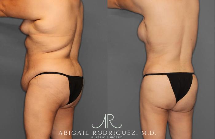 Before & After Tummy Tuck Case 259396 View 5 View in Houston, TX