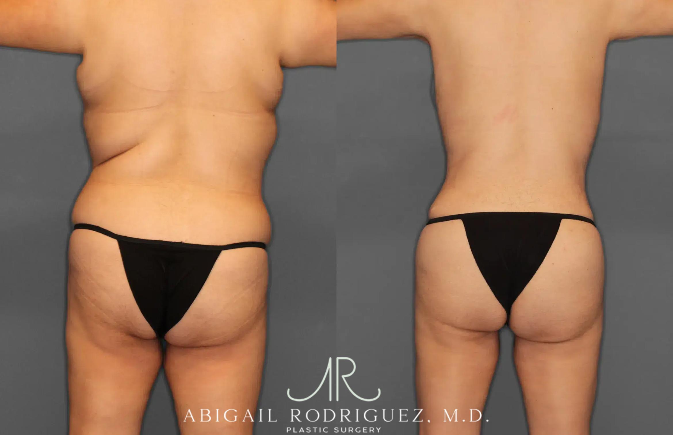 Before & After Tummy Tuck Case 259396 View 6 View in Houston, TX