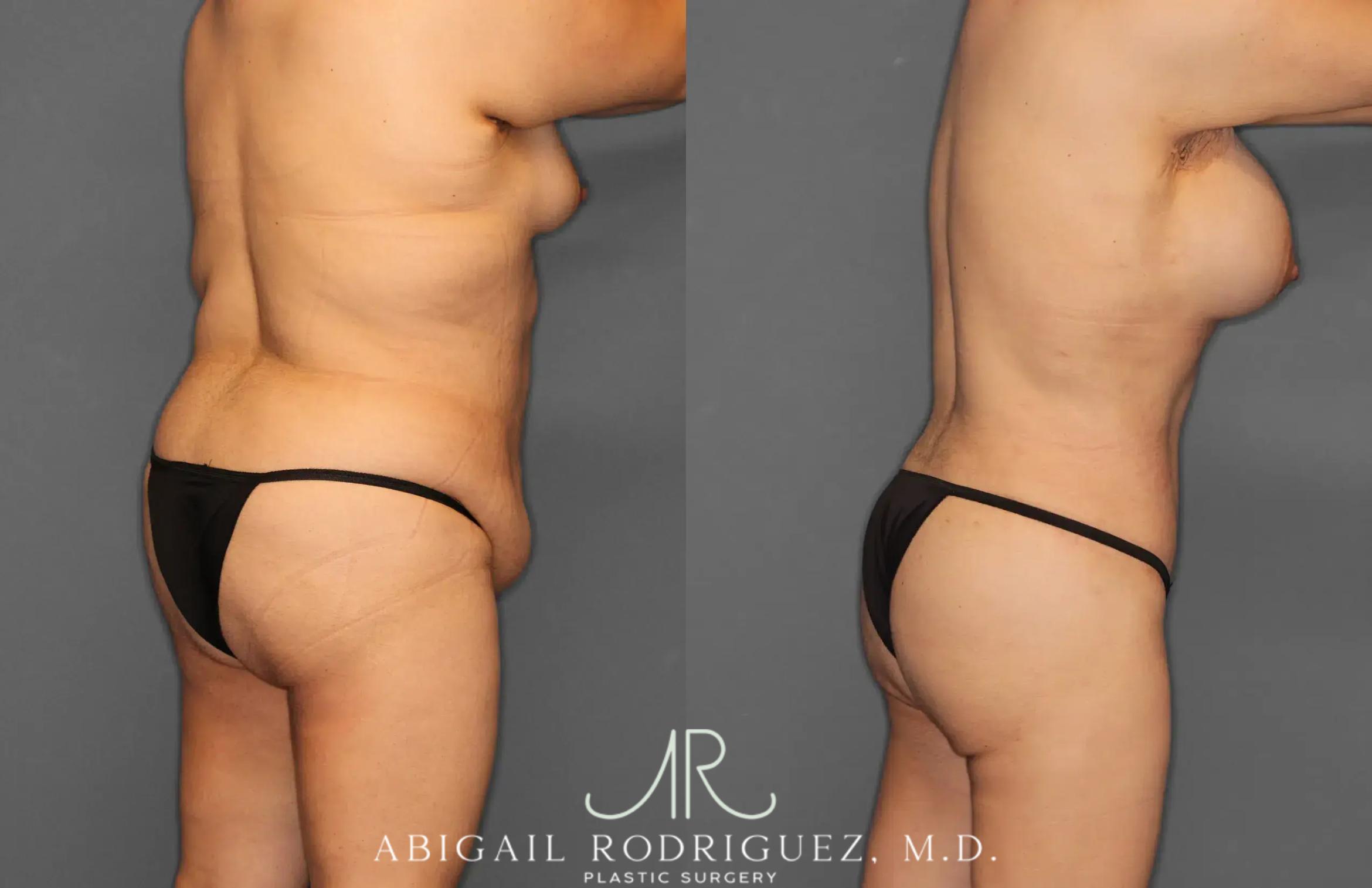 Before & After Tummy Tuck Case 259396 View 7 View in Houston, TX