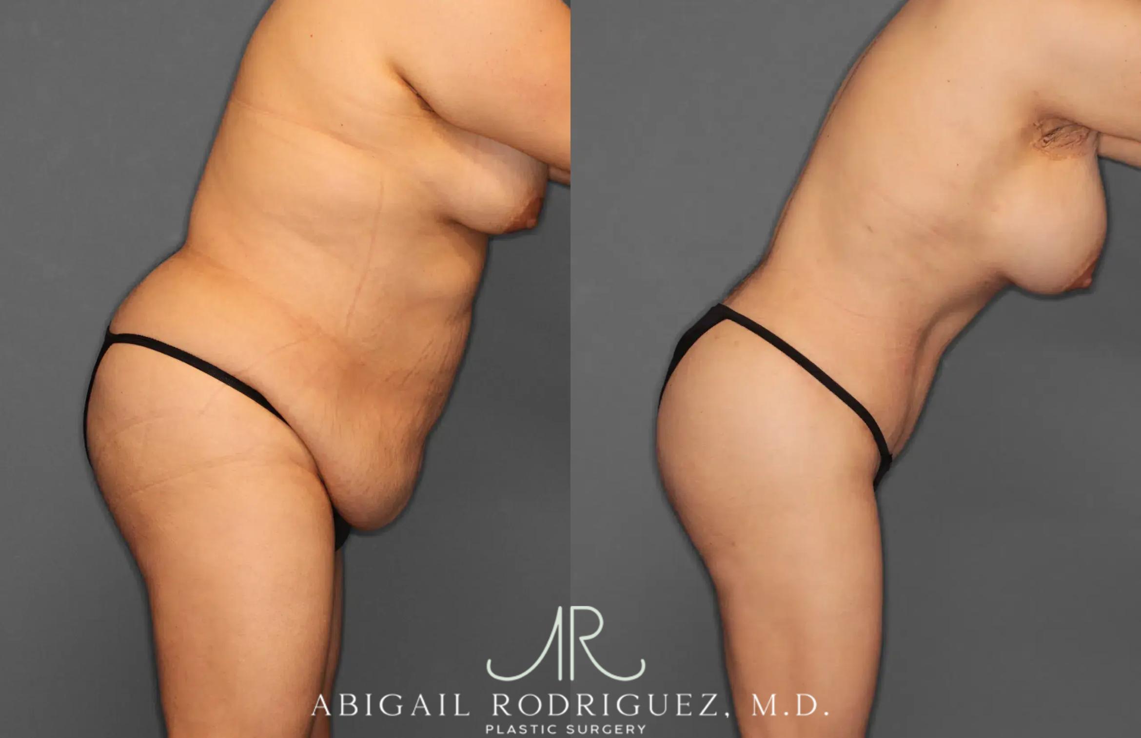 Before & After Tummy Tuck Case 259396 View 8 View in Houston, TX