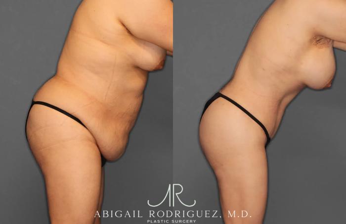 Before & After Tummy Tuck Case 259396 View 8 View in Houston, TX