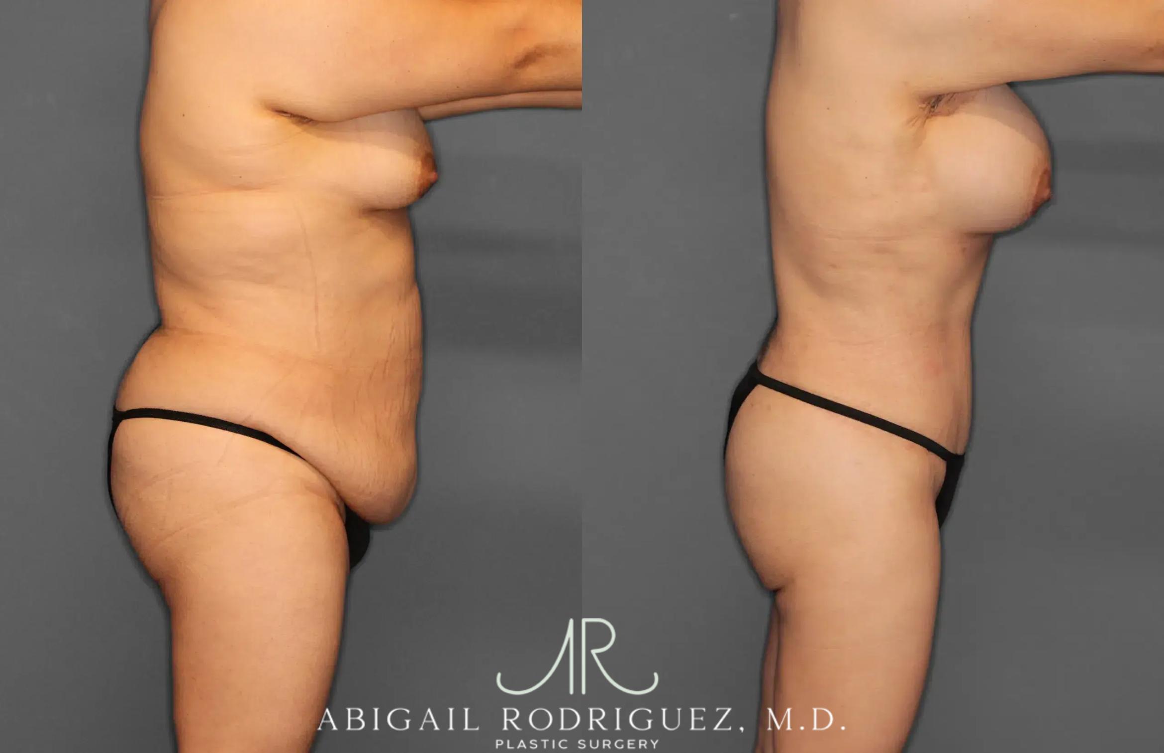 Before & After Tummy Tuck Case 259396 View 9 View in Houston, TX