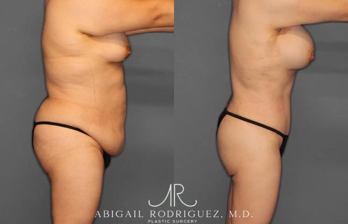 Before & After Tummy Tuck Case 259396 View 9 View in Houston, TX