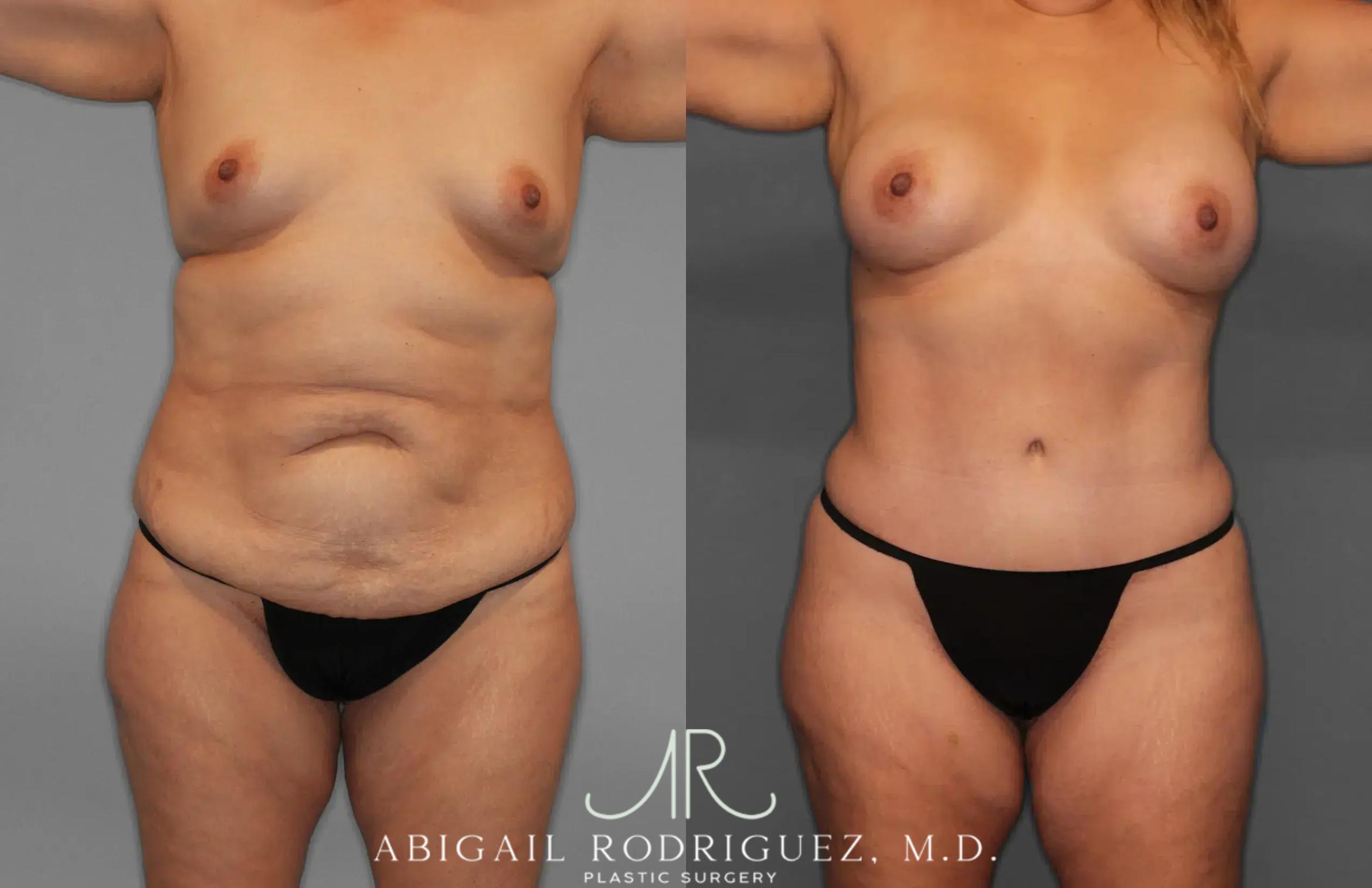Before & After Tummy Tuck Case 259435 View 1 View in Houston, TX